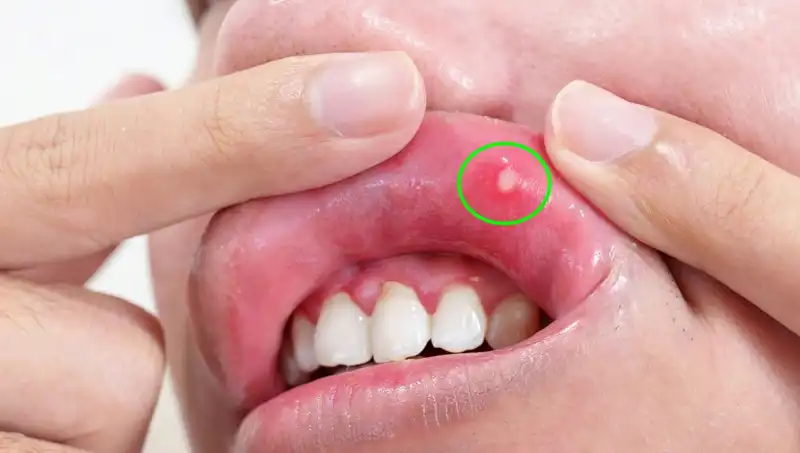 B Vitaminleri Eksikliği: Belirtiler ve Sağlığınız Üzerindeki Etkisi