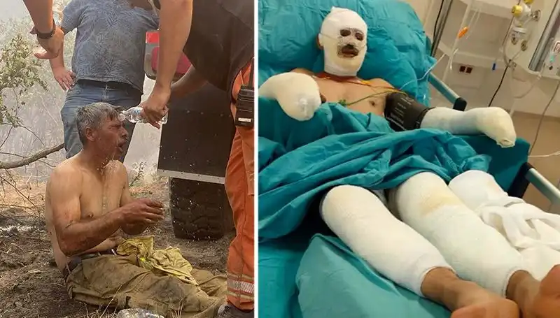 Orman Yangınında Yanarak Yaralanan İşçinin Hayati Tehlikesi Devam Ediyor